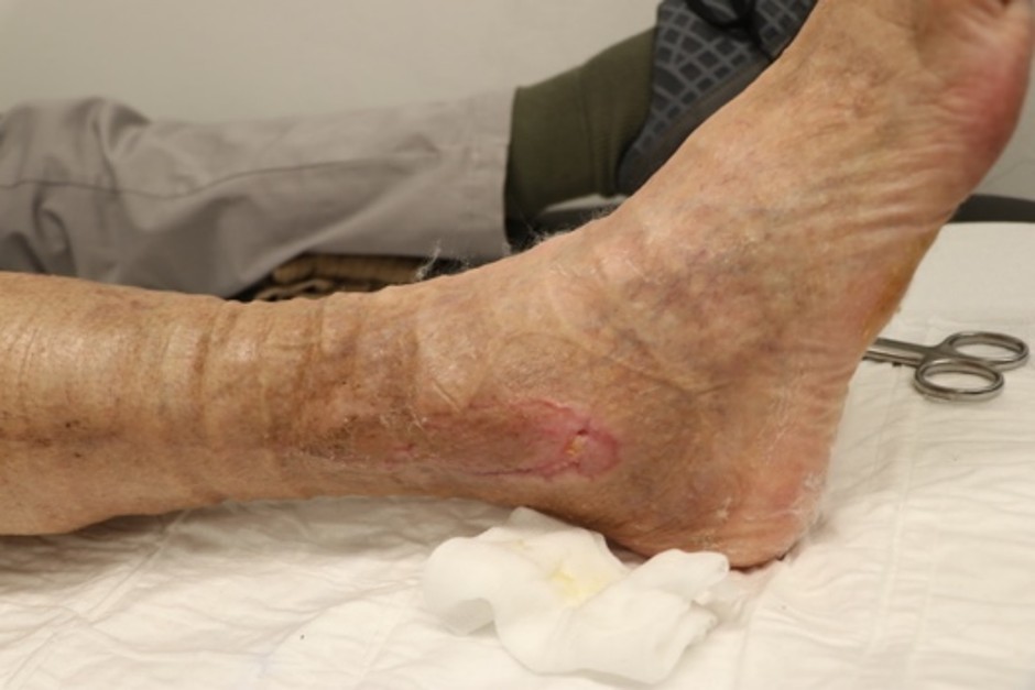 Chronische Wunde, geschlossen