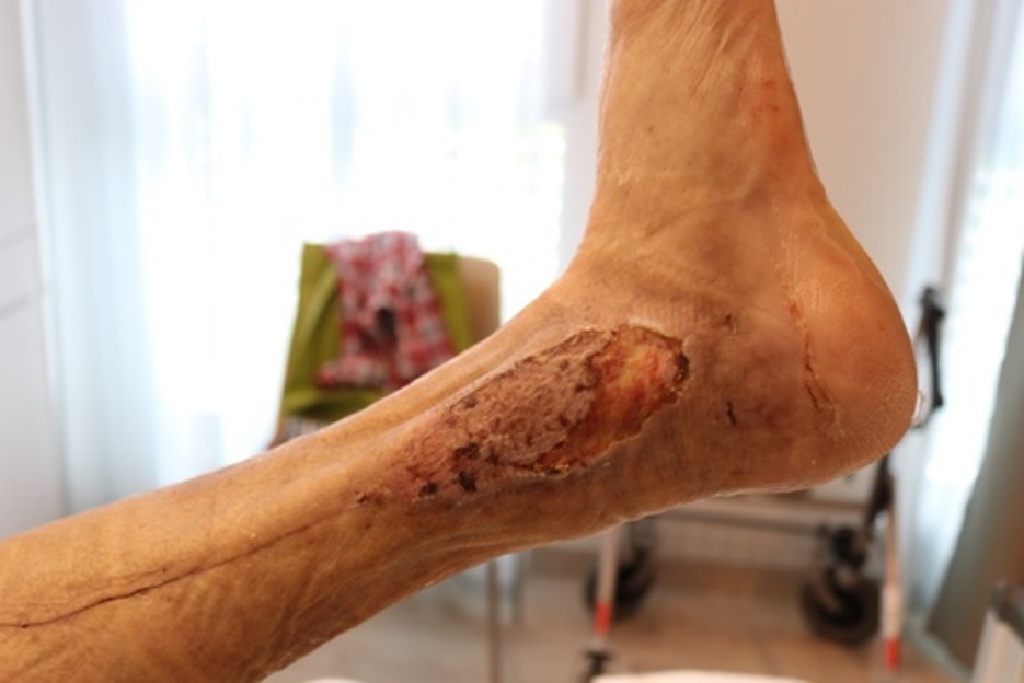 Chronische Wunde, offenes Bein