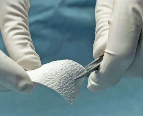 Fish skin, chronic wound treatment, Cassel Wound Center, Kassel - Germany